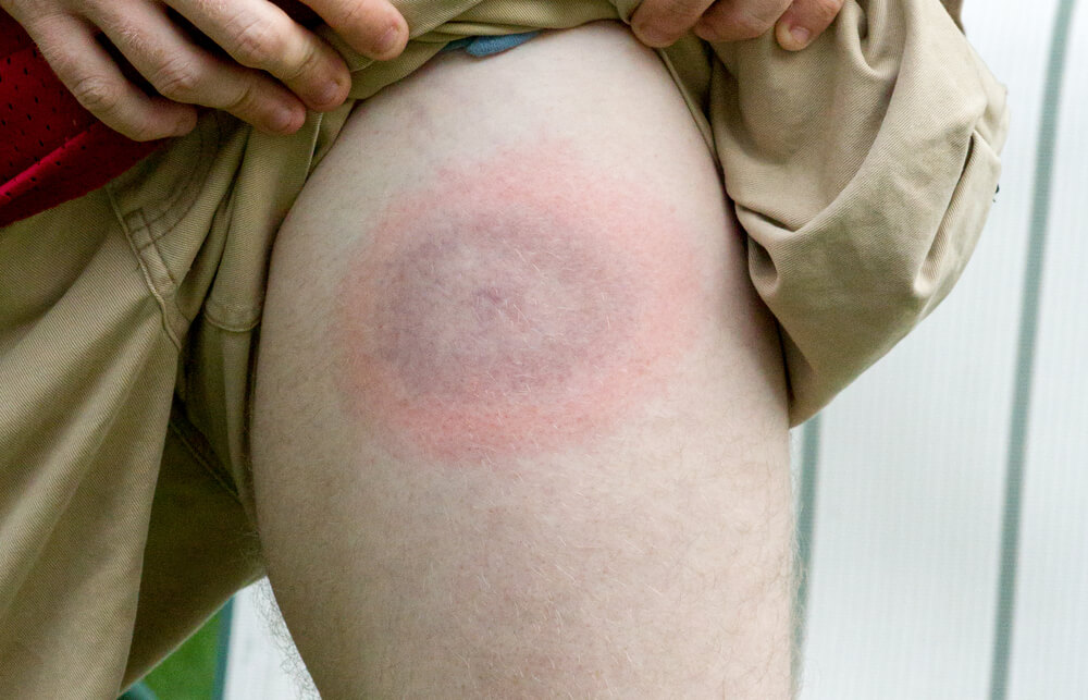 tick bite symptoms
