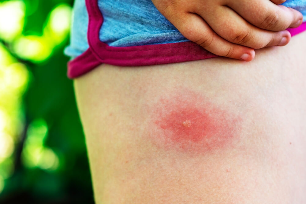 tick diseases