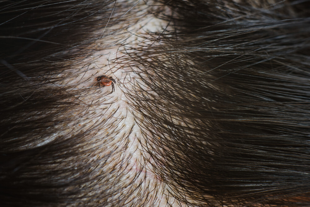 tick removal