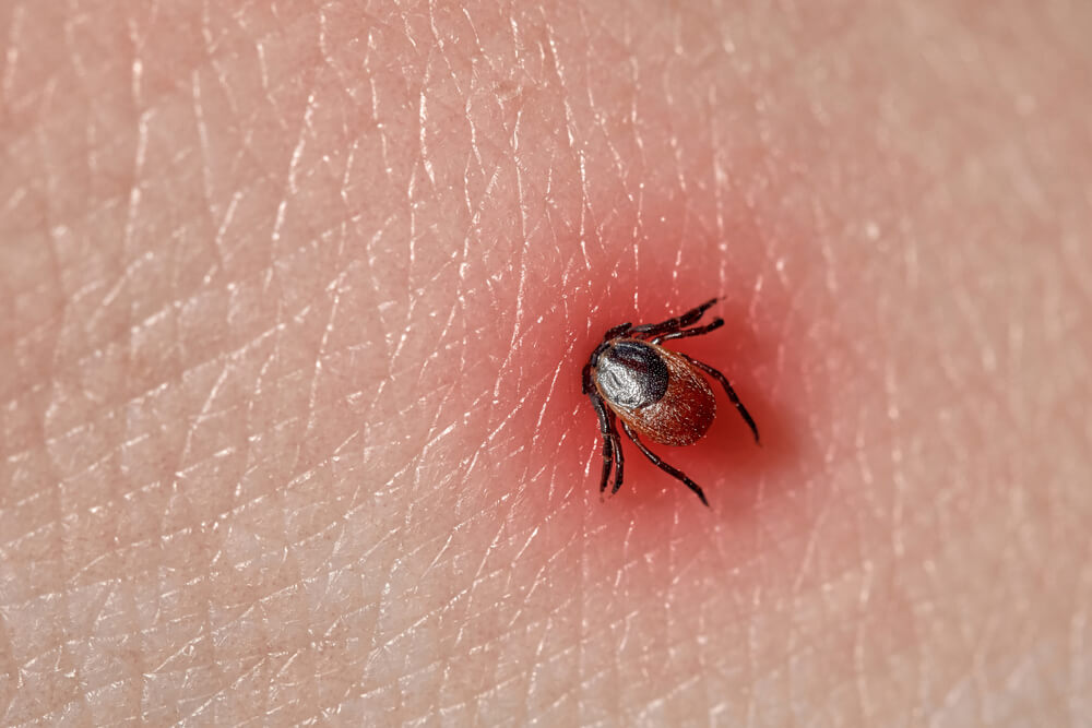 how to remove a tick