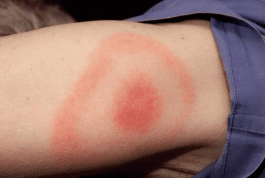 tick diseases